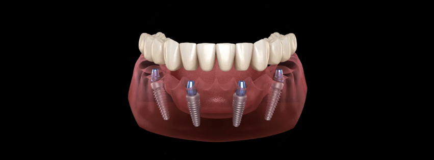 Full arched fixed teeth diagram for dental implants